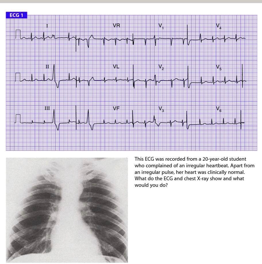 SOLVED ECG 1 VR This ECG was recorded from a 20yearold student who