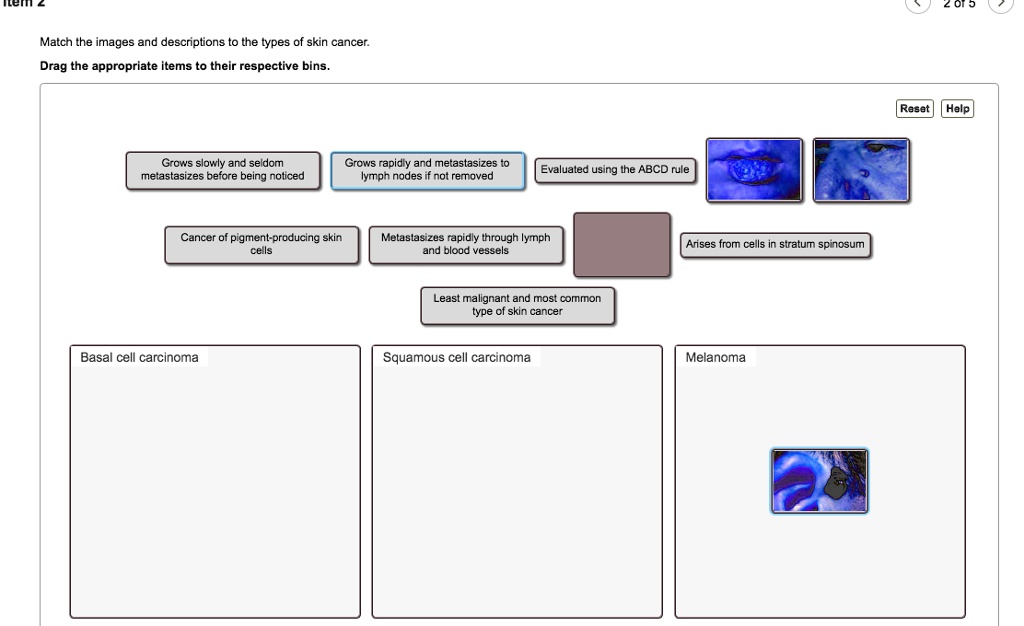 Match the images and descriptions to the types of skin cancer.
Drag the appropriate items to their respective bins.
Grows slowly and seldom metastasizes before being noticed
Grows rapidly and metastasizes to lymph nodes if not removed
Evaluated using the ABCD rule
Cancer of pigment-producing skin cells
Metastasizes rapidly through lymph and blood vessels
Arises from cells in stratum spinosum
Least malignant and most common type of skin cancer
Basal cell carcinoma
Squamous cell carcinoma
Melanoma