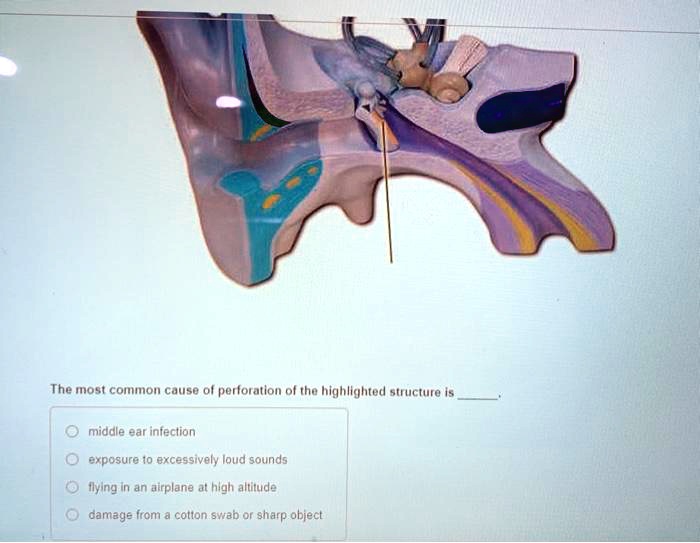 The most common cause of perforation of the highlighted structure is .

middle ear infection
exposure to excessively loud sounds
flying in an airplane at high altitude
damage from a cotton swab or sharp object