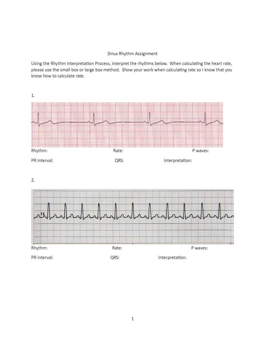 Sinus Rhythm Assignment Using the Rhythm Interpretation Process ...