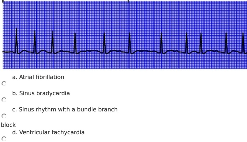 SOLVED: 'a. Atrial fibrillation b. Sinus bradycardia C. Sinus rhythm ...