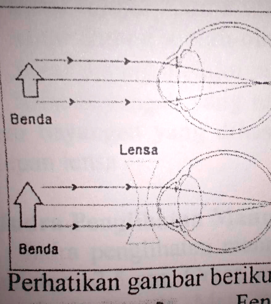 SOLVED: Kelainan Yang Diderita Oleh Mata Pada Gambar Diatas Adalah ...