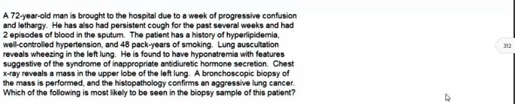 A 72-year-old man is brought to the hospital due to a week of progressive confusion and lethargy. He has also had persistent cough for the past several weeks and had 2 episodes of blood in the sputum. The patient has a history of hyperlipidemia, well-controlled hypertension, and 48 pack-years of smoking. Lung auscultation reveals wheezing in the left lung. He is found to have hyponatremia with features suggestive of the syndrome of inappropriate antidiuretic hormone secretion. Chest x-ray reveals a mass in the upper lobe of the left lung. A bronchoscopic biopsy of the mass is performed, and the histopathology confirms an aggressive lung cancer. Which of the following is most likely to be seen in the biopsy sample of this patient?