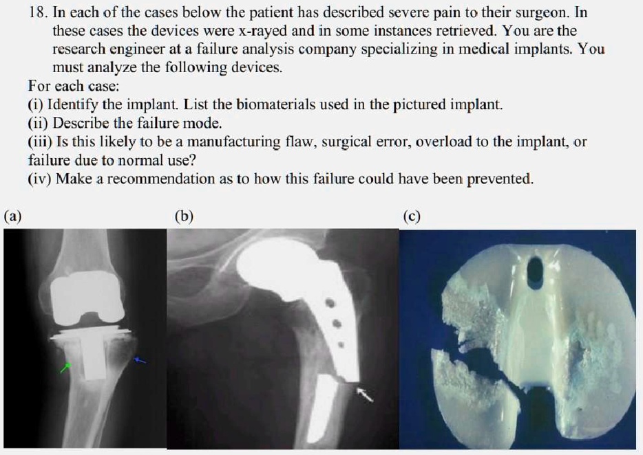 18. In each of the cases below the patient has described severe pain to their surgeon. In these cases the devices were x-rayed and in some instances retrieved. You are the research engineer at a failure analysis company specializing in medical implants. You must analyze the following devices.
For each case:
(i) Identify the implant. List the biomaterials used in the pictured implant.
(ii) Describe the failure mode.
(iii) Is this likely to be a manufacturing flaw, surgical error, overload to the implant, or failure due to normal use?
(iv) Make a recommendation as to how this failure could have been prevented.