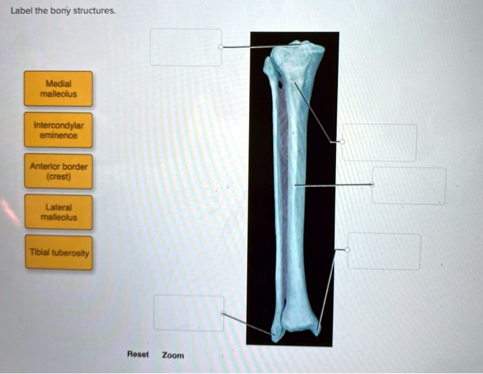 SOLVED: Label the bony structures: - Medial malleolus - Intercondylar