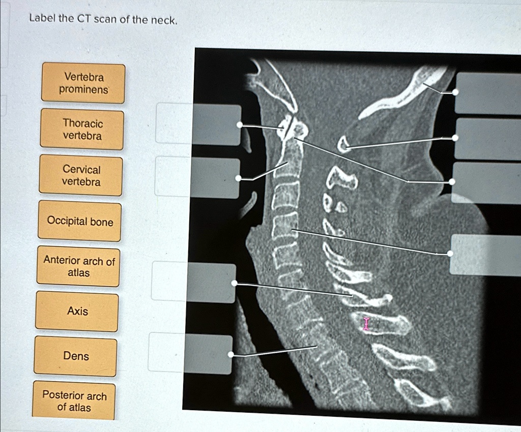 Label the CT scan of the neck: - Anterior arch of atlas - Posterior ...