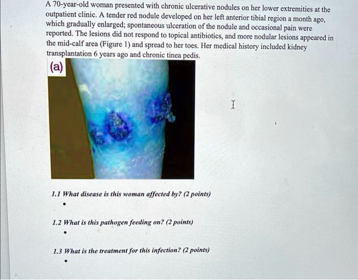 A 70-year-old woman presented with chronic ulcerative nodules on her lower extremities at the outpatient clinic. A tender red nodule developed on her left anterior tibial region a month ago, which gradually enlarged; spontaneous ulceration of the nodule and occasional pain were reported. The lesions did not respond to topical antibiotics, and more nodular lesions appeared in the mid-calf area (Figure 1) and spread to her toes. Her medical history included kidney transplantation 6 years ago and chronic tinea pedis.

1.1 What disease is this woman affected by? (2 points)

1.2 What is this pathogen feeding on? (2 points)

1.3 What is the treatment for this infection? (2 points)