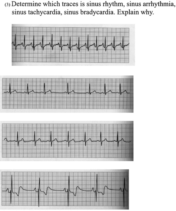 SOLVED: (3) Determine which traces is sinus rhythm, sinus arrhythmia ...