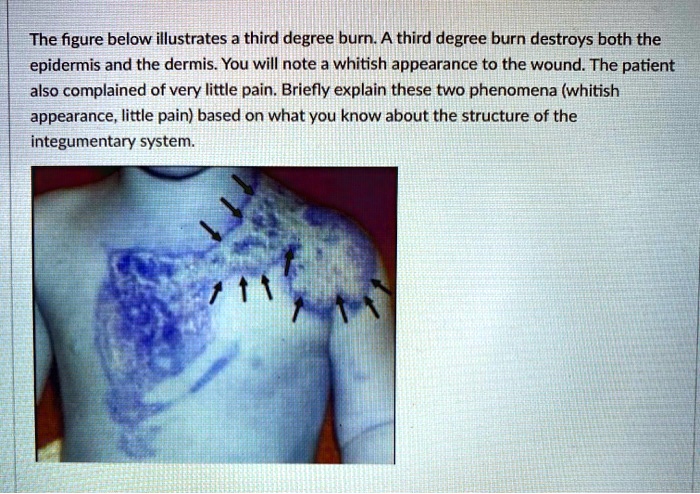 SOLVED: The figure below illustrates a third degree burn. A third ...