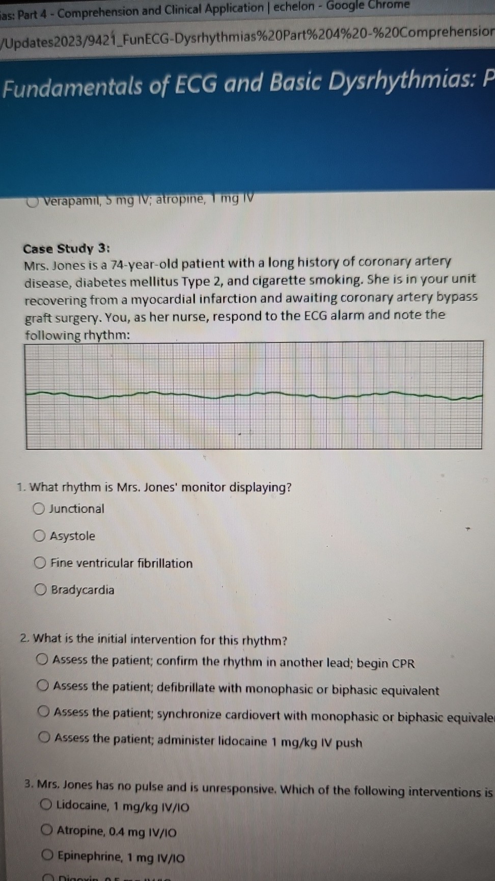 Case Study 3:
Mrs. Jones is a 74-year-old patient with a long history of coronary artery disease, diabetes mellitus Type 2, and cigarette smoking. She is in your unit recovering from a myocardial infarction and awaiting coronary artery bypass graft surgery. You, as her nurse, respond to the ECG alarm and note the following rhythm:

1. What rhythm is Mrs. Jones' monitor displaying?
Junctional
Asystole
Fine ventricular fibrillation
Bradycardia

2. What is the initial intervention for this rhythm?
Assess the patient; confirm the rhythm in another lead; begin CPR
Assess the patient; defibrillate with monophasic or biphasic equivalent
Assess the patient; synchronize cardiovert with monophasic or biphasic equivalent
Assess the patient; administer lidocaine 1 mg/kg IV push

3. Mrs. Jones has no pulse and is unresponsive. Which of the following interventions is
Lidocaine, 1 mg/kg IV/IO
Atropine, 0.4 mg IV/IO
Epinephrine, 1 mg IV/IO