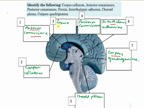 lab-11exercise11-8-identify-the-following-corpus-callosumanterior-commissure-posterior-commissurefornixinterthalamic-adhesionchoroid-plexuscorpora-quadrigemina-6-license-anatomy-physiology-l-82532