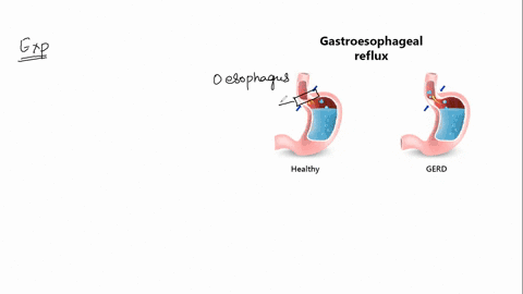 acidic-chyme-splashes-into-the-esophagus-causing-a-burning-pain-commonly-called-heartburn-or-acid-indigestion-this-can-happen-when-the-gastroesophageal-sphincter-does-not-close-properly-a-pe-84884