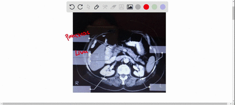 label-the-ct-scan-of-the-abdominal-contents-usirg-the-hints-provided-pancreas-duodenum-left-kidney-right-kidney-liver-spleen-47139
