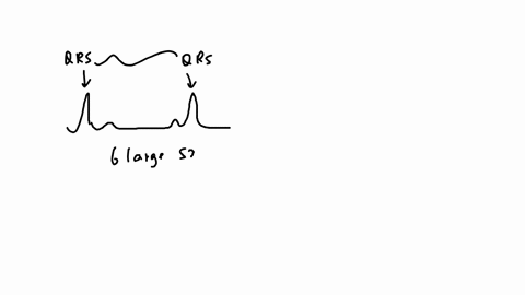flag-question-in-the-following-ecg-which-of-the-following-sentences-is-correct-a-the-heart-rate-is-125-mathrmbeat-mathrmmin-so-the-person-has-tachycardia-b-the-heart-rate-is-50-beatmin-so-the-person-h