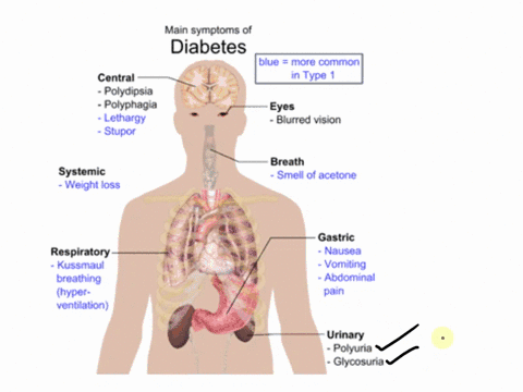signs-and-symptoms-of-type1-diabetes-mellitus-84093