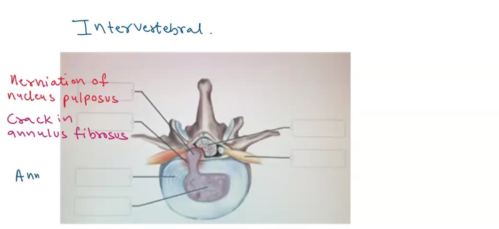 Video Solution Correctly Label The Following Anatomical Features Of An Intervertebral Disc And