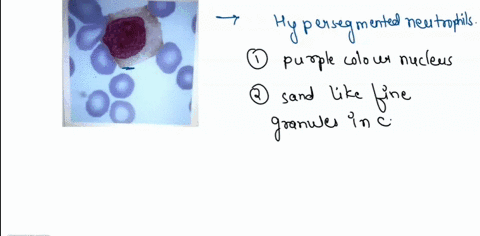 blast-giant-platelet-hairy-lymphocyte-hypersegmented-neutrophil-hypogran-eosinophil-large-granular-lymph-metamyelocyte-monocyte-myclocyte-55752