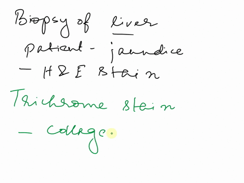 biopsy-was-performed-on-a-patient-presented-with-jaundice-and-with-history-of-heavy-alcohol-intake-biochemical-tests-showed-abnormal-liver-function-he-staining-was-carried-out-and-the-image-71093