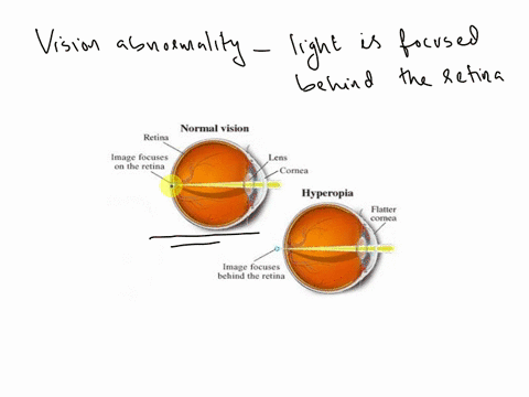 what-vision-abnormality-occurs-when-light-is-focused-behind-the-retina-23727