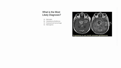 what-is-the-most-likely-diagnosis-a-meningitis-b-glioblastoma-multiforme-c-subarachnoid-hemorrhage-d-meningioma