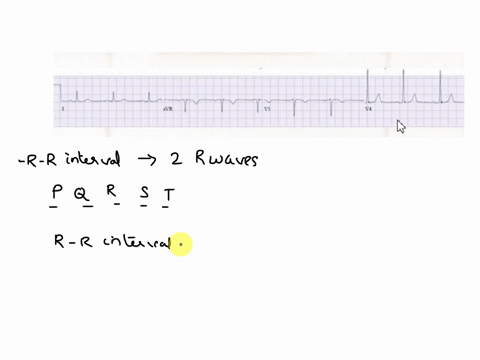 to measure the r to r interval where do you need to place the cursors ...