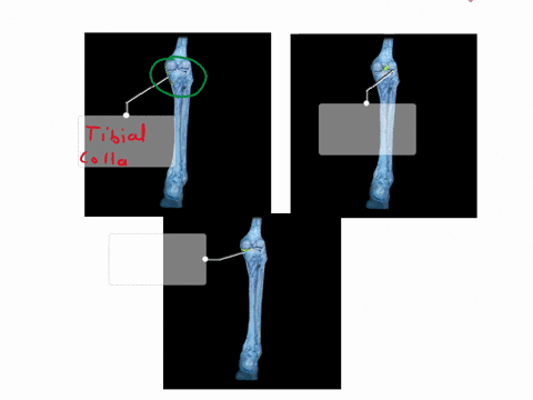 indicate-the-components-of-the-unhappy-triad-indicate-the-components-of-theunhappy-triad-fibular-collateral-ligament-medial-meniscus-lateralmeniscus-tibial-collateral-ligament-posterior-cruc-03148