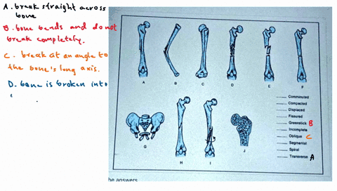 bone-fractures-comminuted-compacted-displaced-fissured-greenstick-incomplete-oblique-segmental-spiral-transverse-79194