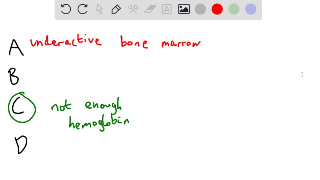 SOLVED The correct answer is d. Iron deficiency anemia and thalassemia