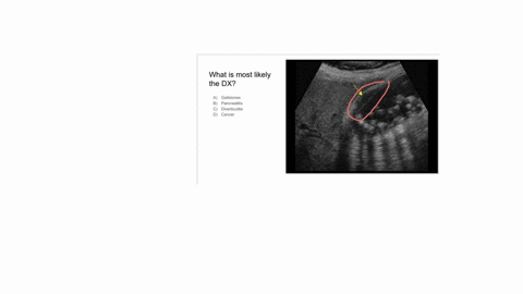 what-is-most-likely-the-dx-a-gallstones-b-pancreatitis-c-diverticulitis-d-cancer