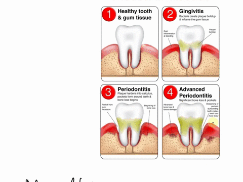 name-oral-microbiology-part-answer-tne-following-questions-whatis-gingivitis-what-perodonitis-hova-docs-microbial-flora-healtny-periodontist-differ-from-microbial-flora-of-a-diseased-periodo-02398