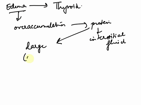 edema-refers-to-tissue-swelling-and-this-occurs-when-fluid-is-drawn-out-of-the-blood-plasma-and-into-the-interstitial-fluid-of-the-tissues-one-symptom-of-certain-forms-of-thyroid-disease-res-85765