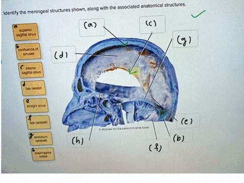 ldentify-the-meningeal-structures-shownalong-with-the-associated-anatomical-structures-superior-sagital-sinus-confluence-of-sinuses-inferior-sagittal-sinus-falx-cerebn-straight-sinus-tabxcer-65447