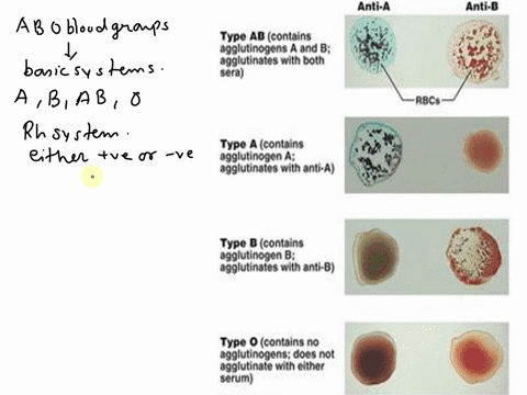 determine-blood-type-for-abo-system-given-the-following-results-what-antigens-are-present-on-the-blood-tested-rh-what-is-the-blood-type-of-the-sample-24305