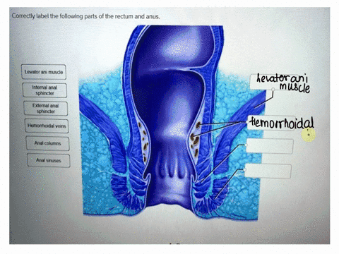 Rectal Part Correctly label the following parts of the large intestine. External ...