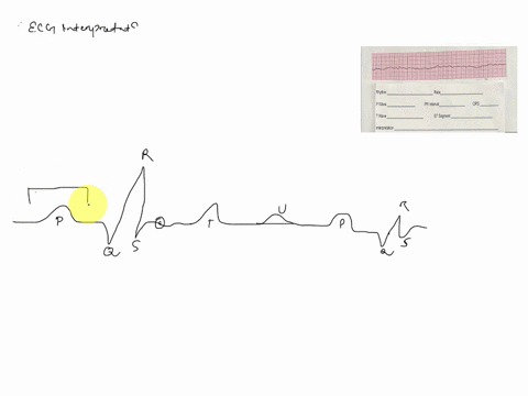 can-someone-help-rhythm-rate-p-wave-printerval-qrs-twave-st-segment-interpretation-37532