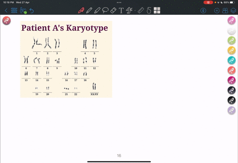 patient-a-is-the-nearly-full-term-fetus-of-a-forty-year-old-female-chromosomes-were-obtained-from-fetal-epithelial-cells-acquired-through-amniocentesis-lab-technicians-compile-karyotypes-and-75773