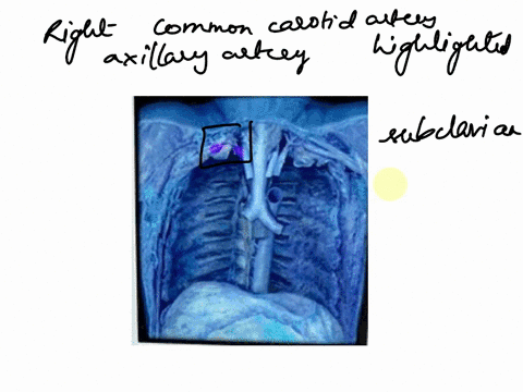 what-sctructure-is-highlighted-which-structure-is-highlighted-multiple-choice-rightcommon-carotid-right-axillary-artery-right-subclavian-artery-right-brachial-artery-75938