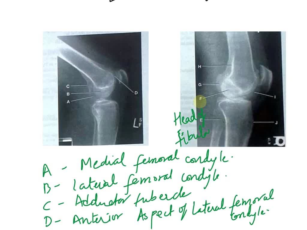 SOLVED Anterior cruciate ligament Articular cartilage Bursae Femur