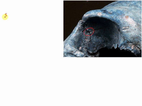 q11-homework-o-unanswered-look-carefully-at-this-imagethis-individual-was-stabbed-in-the-eye-with-a-sharp-objectlikely-a-knifethe-primary-impact-site-is-visible-within-the-eye-socket-however-63573