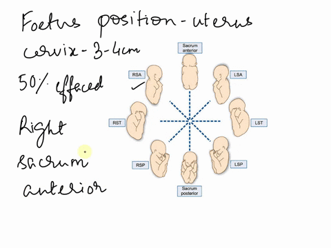 physical-assessment-of-a-client-in-active-labor-reveals-that-the-cervix-is-dilated-3-to-4-cm-and-50-effaced-the-fetus-is-in-the-right-sacrum-anterior-rsa-position-and-contractions-are-5-minu-18785