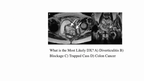 what-is-the-most-likely-dx-a-diverticulitis-b-blockage-c-trapped-cass-d-colon-cancer