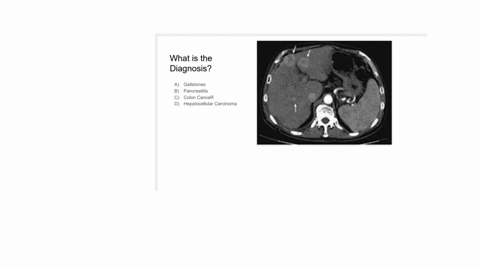 what-is-the-diagnosis-a-gallstones-b-pancreatitis-c-colon-cancer-d-hepatocellular-carcinoma