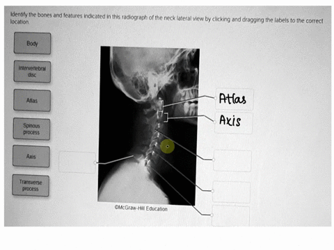 location-identify-the-bones-and-features-indicated-in-this-radiograph-of-the-neck-lateral-view-by-clicking-and-dragging-the-labels-to-the-correct-body-intervertebral-disc-atlas-spinous-proce-93434