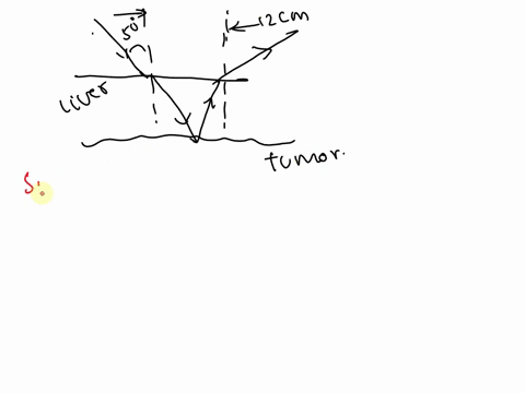 a-narrow-beam-of-ultrasonic-waves-reflects-off-the-liver-tumor-illustrated-in-figure-p-3520-the-spee-05718