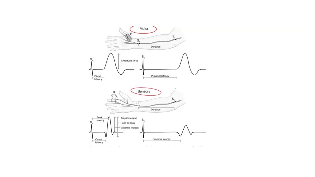 SOLVED Please describe the procedure of measuring the nerve conduction