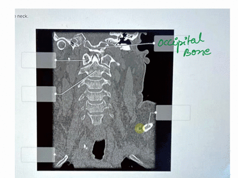 label-the-ct-scan-of-the-neck-6-occipital-bone-025718-clavicle-atlas-axis-rib-1-reset-zoom-72111