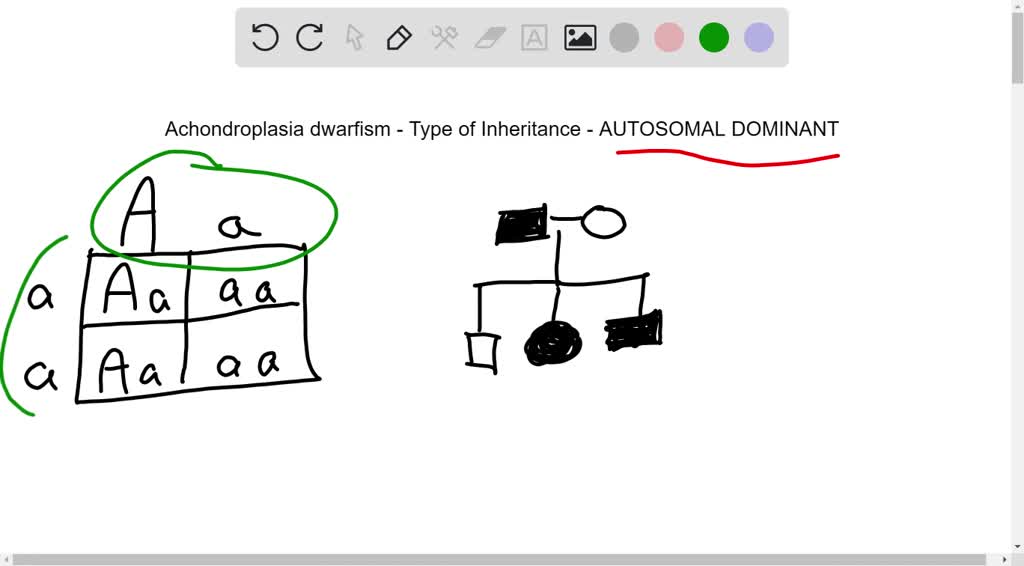 Solved 3 Achondroplasia Is A Common Form Of Hereditary Dwarfism That