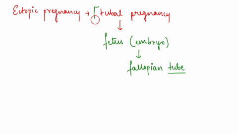an-ectopic-pregnancy-occurs-when-the-preembryo-implants-somewhere-other-than-in-the-uterus-such-as-2-32963