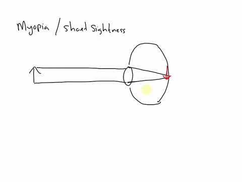 explain-with-the-help-of-a-labelled-ray-diagram-the-defect-of-myopia-and-how-it-is-corrected-34477