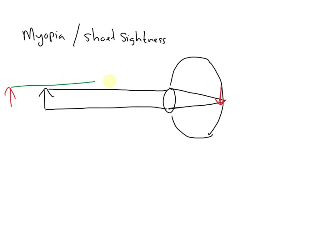 SOLVED: Explain with the help of a labelled ray diagram the defect of ...